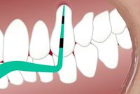 фасети - 62090 вида | Medical Dent фасети - 89355 вида