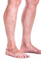 разширени вени лечение - 81657 комбинации