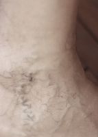 разширени вени лечение - 31574 клиенти