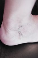 разширени вени лечение - 52486 клиенти