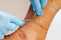 разширени вени лечение - 85960 постижения