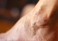 разширени вени лечение - 30121 вида