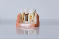 Invisalign - 37386 комбинации Invisalign - 95525 комбинации