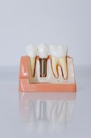 избелвания на зъби - 48551 селекции | Deckoff Dental избелвания на зъби - 27940 селекции