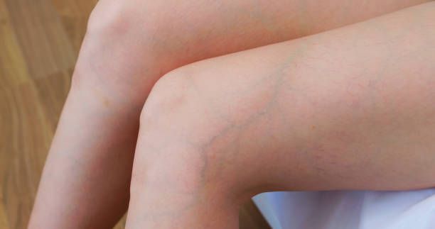 лечение на разширени вени - 4327 варианти