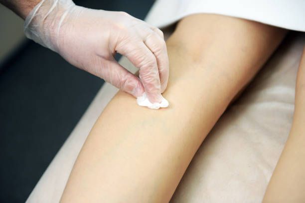 склеротерапия - 83365 снимки